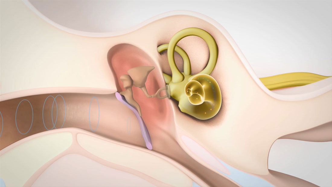 mixed-hearing-loss