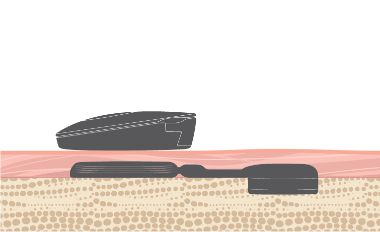 The BONEBRIDGE Active Transcutaneous Bone Conduction Implant System