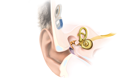 Implan pendengaran yang andal untuk kehidupan sehari-hari