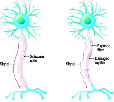 Causes of multiple sclerosis