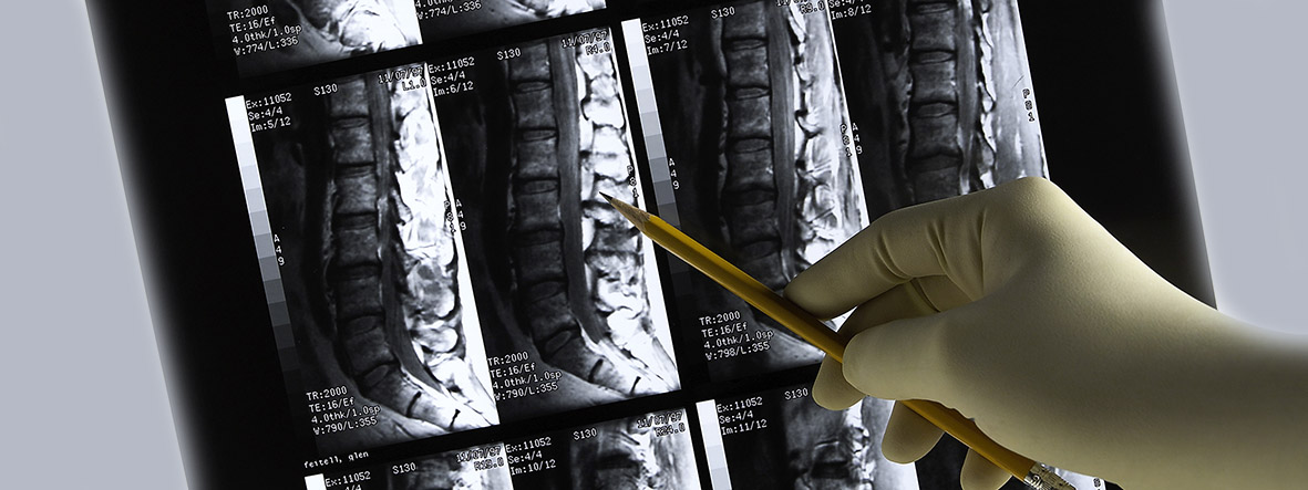 Diagnose einer Querschnittslähmung Diagnose einer Querschnittslähmung