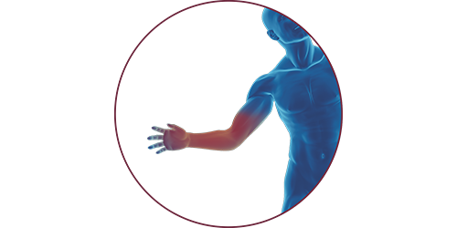 FES bei Handverletzung | STIWELL® Neurorehabilitation