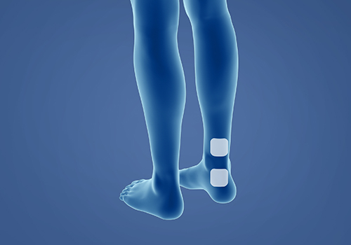 STIWELL therapy | overactive bladder