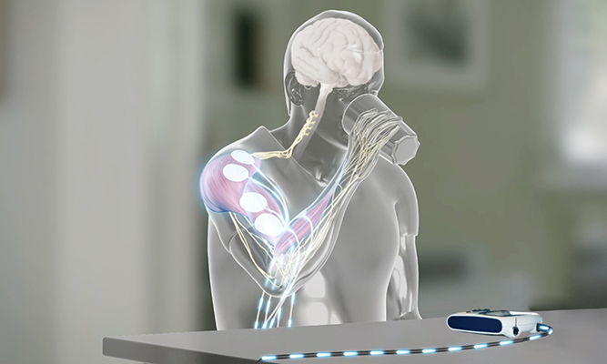 STIWELL® Neurorehabilitation | Funktionsprinzip der FES STIWELL® Neurorehabilitation | Funktionsprinzip der FES