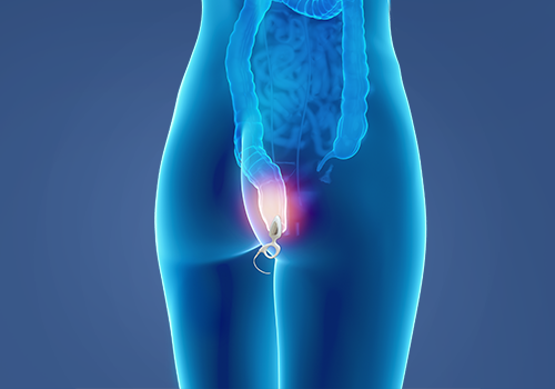 STIWELL® Therapie | Stuhlinkontinenz STIWELL® Therapie | Stuhlinkontinenz