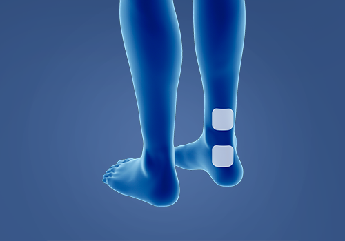 STIWELL® Therapie | Überaktive Blase STIWELL® Therapie | Überaktive Blase