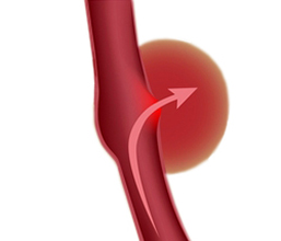 Hirnblutung (hämorrhagischer Schlaganfall) Hirnblutung (hämorrhagischer Schlaganfall)