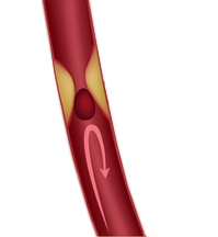 Minderdurchblutung (ischämischer Schlaganfall, Hirninfarkt) Minderdurchblutung (ischämischer Schlaganfall, Hirninfarkt)