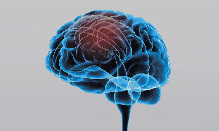 What is a central paresis?