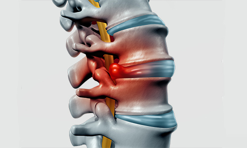 What is a herniated disc?